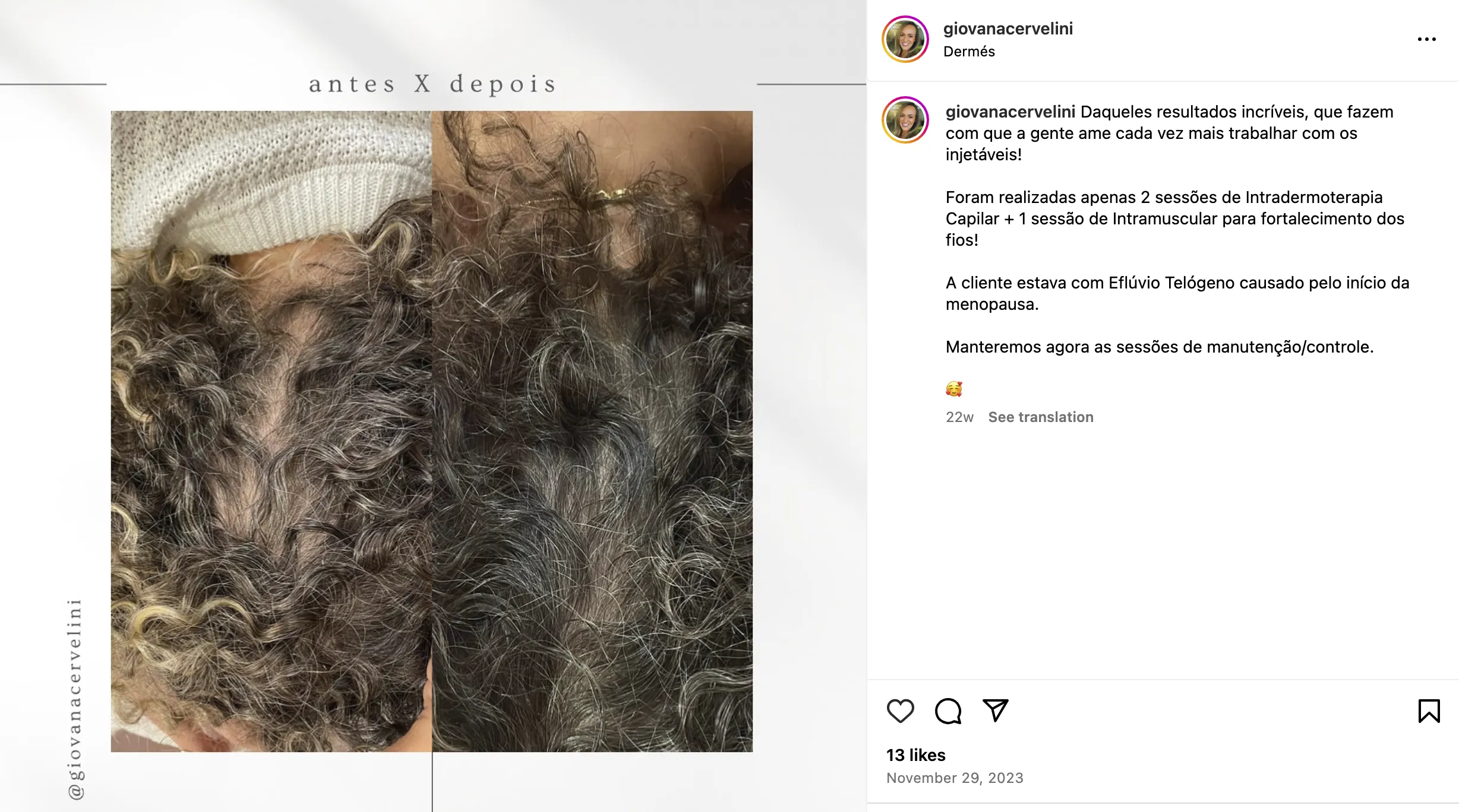 Tratamento da Alopecia